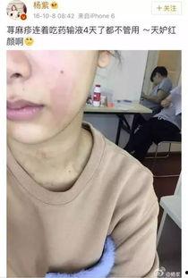 娱乐吃瓜酱过敏,吃瓜酱过敏背后的惊人真相